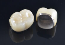 Преимущества установки металлокерамических коронок